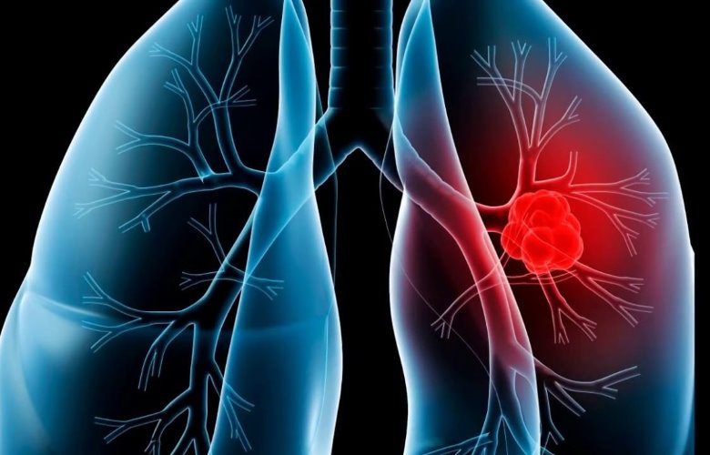 icd 10 history of mesothelioma